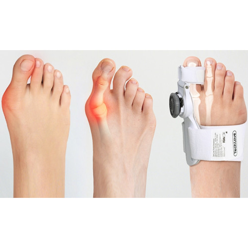 Állítható bütyök korrigáló sín, Hallux Valgus bandázs